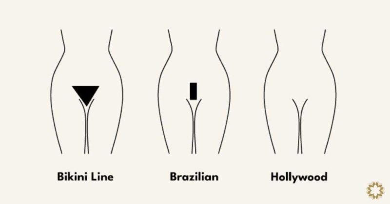 Brazilian Vs. Hollywood Laser Hair Removal: Let'S Get Down To Smooth Business! 1 Hollywood Vs Brazilian Laser Hair Removal Treatment