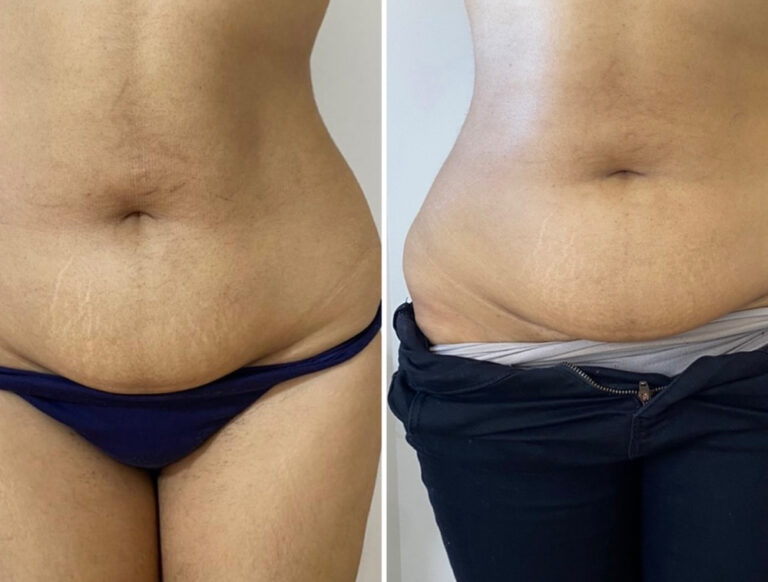 Aqualyx Fat Dissolving Injections Before and After