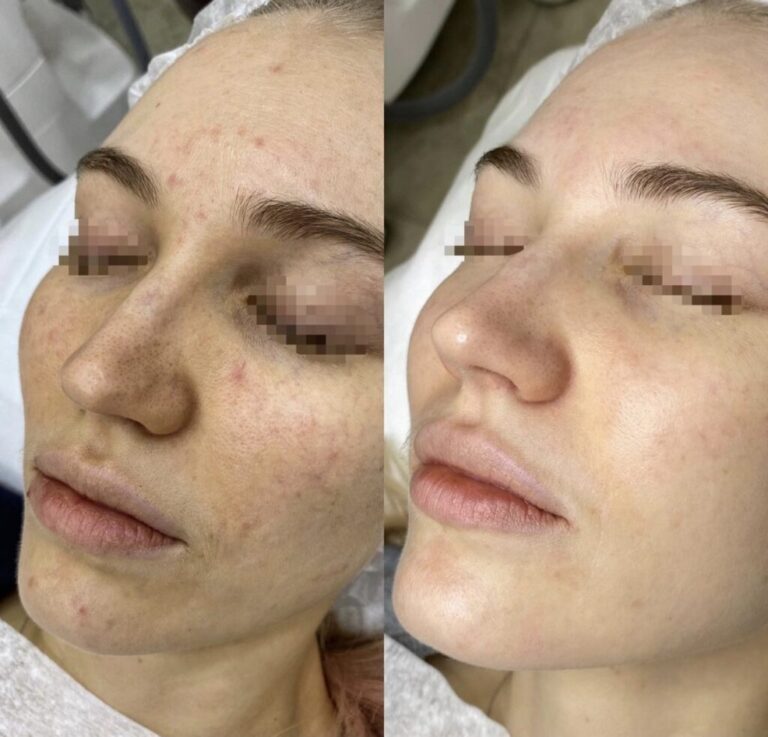 Carbon Laser Peel Before After