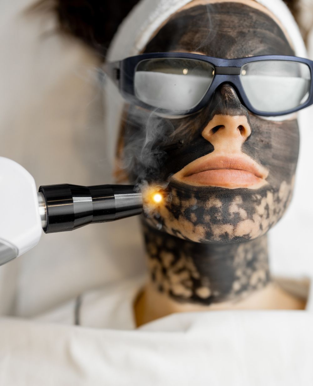 Carbon Laser Peel treatment in Harley street london