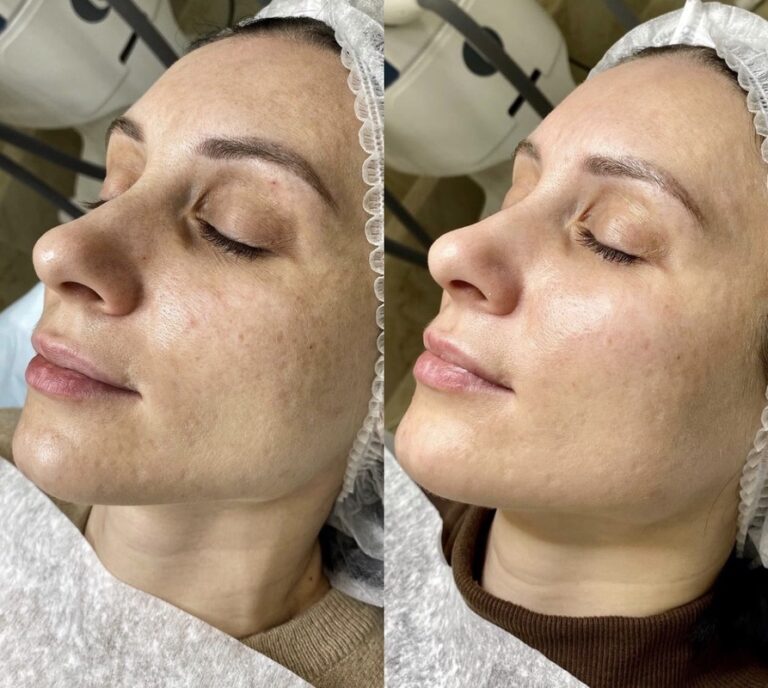 Carbon Laser Peel Before After