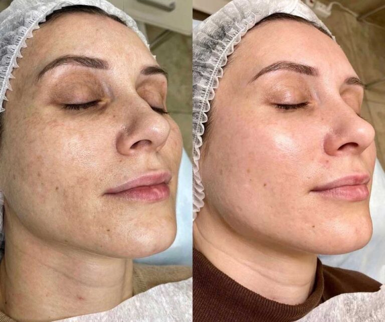 https://skinlogicaesthetics.co.uk/wp-content/uploads/Carbon-Peel-Before-After-02-768x642.jpg