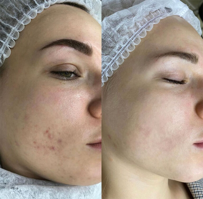 Carbon Laser Peel Before After