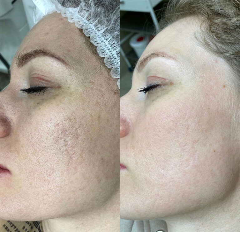 Carbon Laser Peel Before After