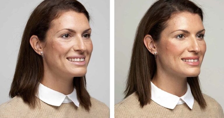 Juvederm Volite Before and After