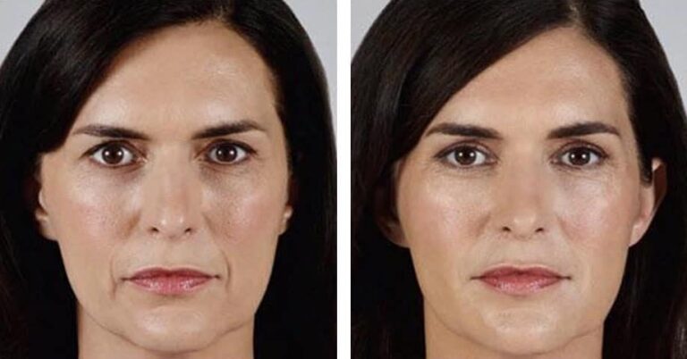 Juvederm Volite Before and After