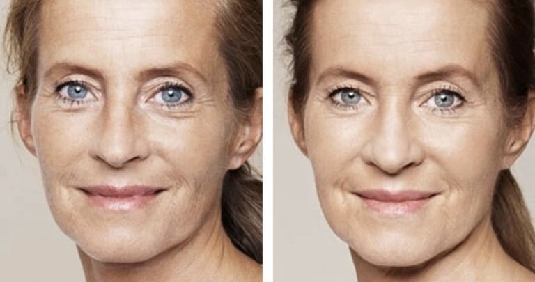 Juvederm Volite Injections Before and After