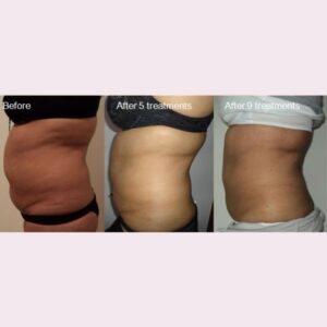 Lipofirm Before After 3 - Skin Logic Aesthetics &Amp; Laser Clinic