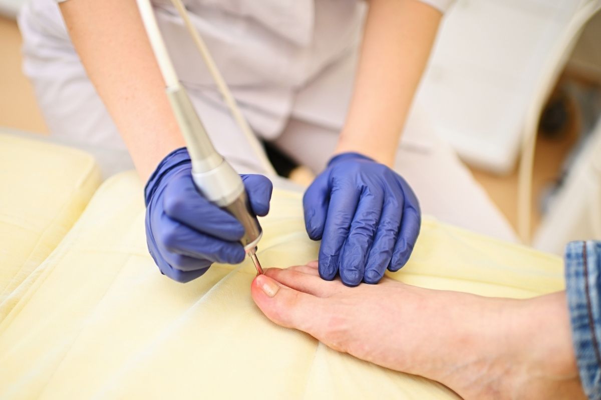 Home 23 Fungal Nail Laser Treatment London